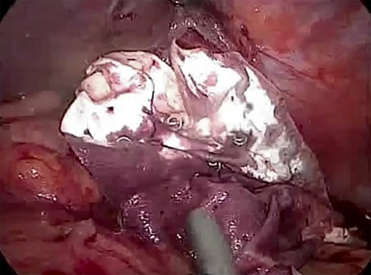 Laparoscopic view showing BIO-A® Tissue Reinforcement absorbable mesh (size 15 × 12 cm) fixed intraperitoneally below the defect.