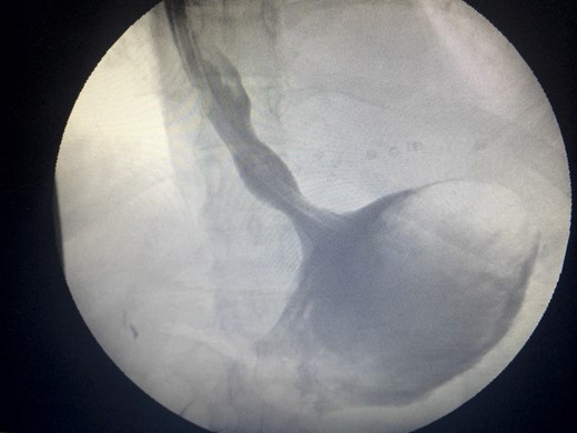 Water-soluble gastrografin meal showing normal intra-abdominal position of the stomach.