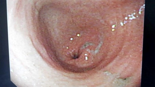 Follow-up flexible upper endoscopy showing normal gastric anatomy.