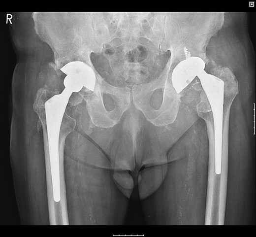 Pelvic radiograph demonstrating superolateral migration of the femoral head, metallic fragments around the neck and bony destruction of the acetabular wall.