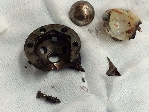 The acetabular component and liner showing extreme wear.