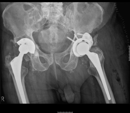 A post-revision radiograph demonstrating a structural graft using the acetabular augment (Regenerex™) and revised cup in situ.
