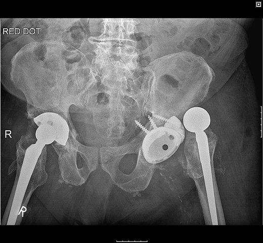 Radiograph following postoperative fall demonstrating posterior dislocation.