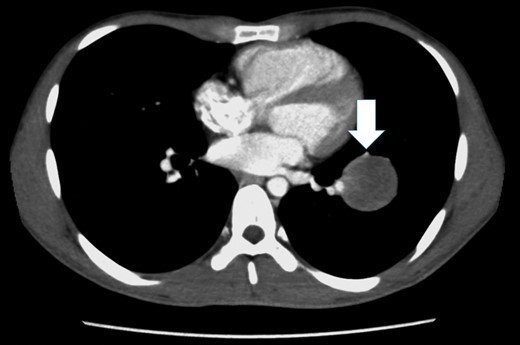 Chest CT shows a tumor with a smooth margin in the left S8 pulmonary segment, close to the interlobar PA, and the lingular segmental artery is compressed by the tumor (white arrow).
