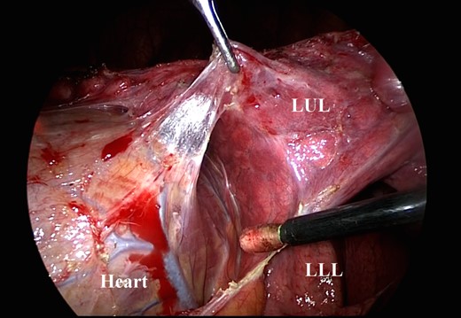 After the dissection between the heart and the lung, the epicardium is seen. LUL, left upper lobe; LLL, left lower lobe.