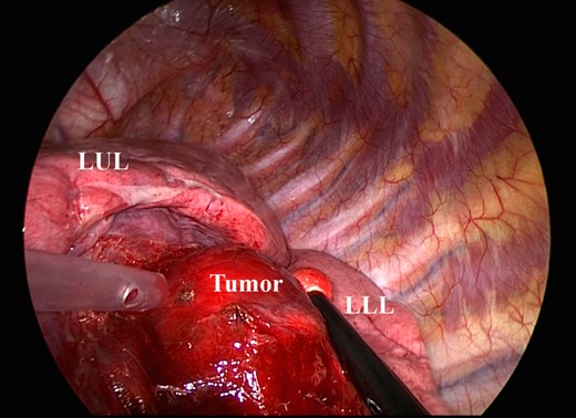 The tumor is located predominantly in the lower lobe, over the left major fissure, and spreads to the left upper lobe. LUL, left upper lobe; LLL, left lower lobe.