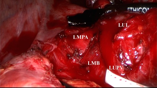 The left upper pulmonary vein was encircled and pulled caudally. The left main PA was exposed. LMPA, left main pulmonary artery; LUPV, left upper pulmonary vein; LMB, left main bronchus; LUL, left upper lobe.