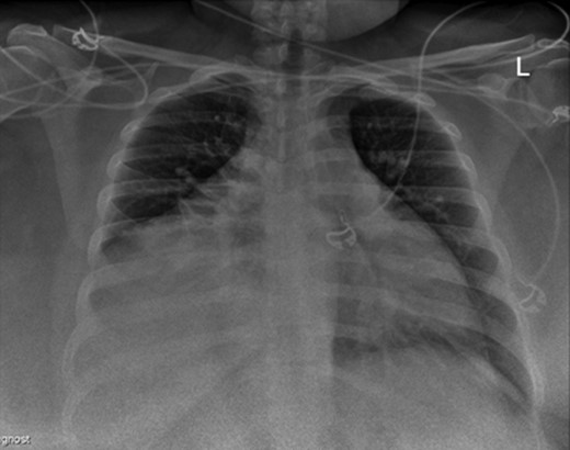 Initial bariatric preoperative chest X-ray that led us to the diagnosis.