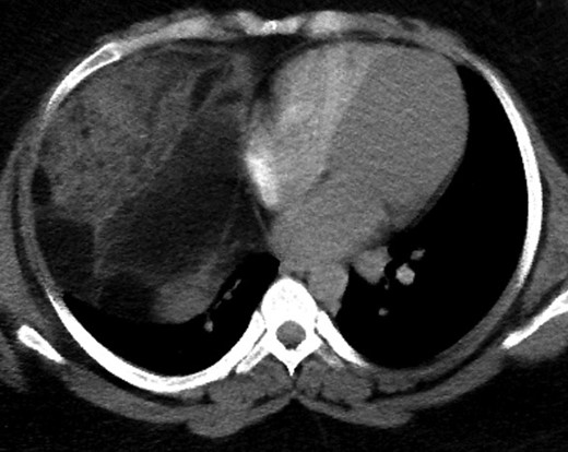 CT image of the mediastinal mass taken preoperatively.