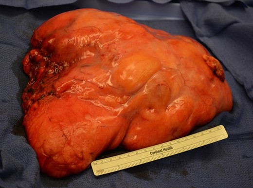 Image of the resected mass.