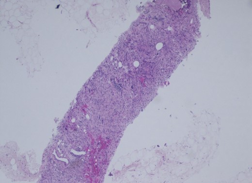 Mediastinal mass, core biopsy. The histology is that of a well-differentiated liposarcoma, sclerosing variant.