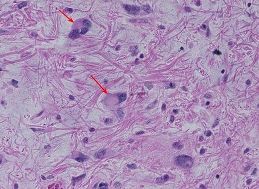 The tumor is composed of atypical spindle cells embedded in fibrous matrix. There are scattered tumor giant cells and rare lipoblasts, as well as numerous floret-like multinucleated giant cells (arrows). Importantly, silver and chromogenic in situ hybridization was performed for MDM2 and shows diffuse amplification.