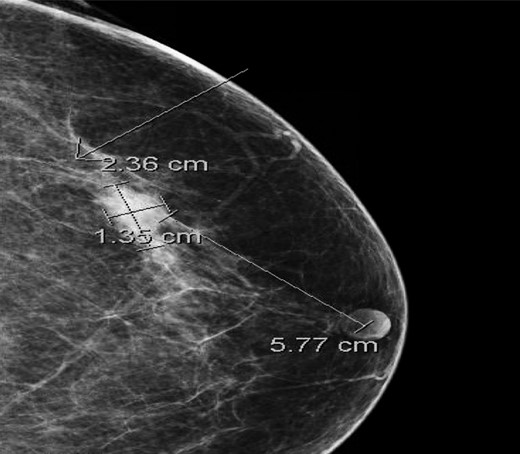 Cranio-caudal view of mammogram showing a 2.4 cm × 1.4 cm × 1.8 cm lobulated mass with an indistinct margin in the left breast at 1 o'clock, 5.8 cm from the nipple.