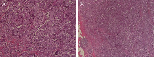Histologic images of the IDC. Magnification ×100. (a) Hematoxylin and eosin (H&E) staining photomicrograph of left breast cancer showing proliferative growth of malignant ductal epithelial cells and (b) invasion under basement membrane.