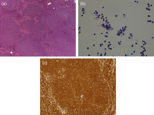 Histologic images of MCL. Magnification ×100. (a) H&E staining showing effaced nodal architecture due to closely packed neoplastic growth of mantle zone B-cells of lymphoid follicles, (b) singly scattered epitheliod histocytes making a starry-sky appearance at a lower magnification and (c) cyclin D1+ immunostaining.