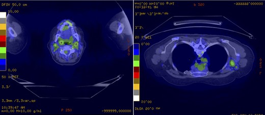PET demonstrating 18F-fluorodeoxyglucose-avid lymphadenopathy of the neck, axilla and mediastinum consistent with the patient's MCL. (a) The largest lymph nodes in the left neck level II measured 16 × 13 mm with a maximal SUV of 4.8. (b) The largest left axillary lymph node measured 26 × 18 mm with an associated maximal SUV of 3.7.