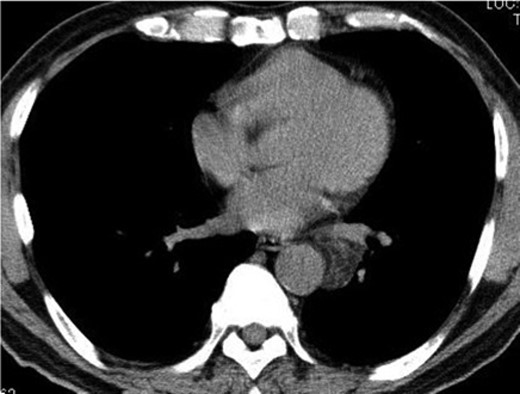 CT from another hospital 2 years earlier shows a 3.2 × 2.4-cm lipomatous tumor at the left hilum adjacent to the left lower pulmonary vein.