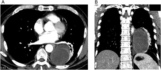 Contrast-enhanced CT of the chest shows an oval, smooth-shaped, heterogeneous tumor displacing the left lower lobe of the lung, measuring 10 × 7.4 × 6 cm on horizontal (A) and coronal (B) sections without pleural effusion or hemothorax.