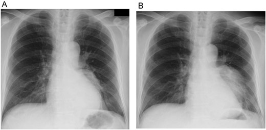 Chest X-ray from the first visit to our hospital (A), and 3 weeks after that initial visit (B). These photos show rapid growth of the left intrathoracic tumor.
