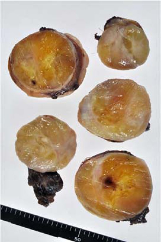 Gross appearance of the tumor. The well-circumscribed mass is encapsulated by fibrous tissue, showing a myxoid appearance intermingled with a whitish, solid part on the cut surface.
