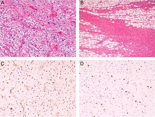 Histopathological findings of the tumor. (A) Myxoid, pleomorphic component. (B) Well-differentiated liposarcoma component. Positive immunoreactions for CDK4 (C) and MDM2 (D) in the nuclei of tumor cells, confirming the diagnosis of dedifferentiated liposarcoma.