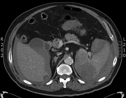CT scan showing the abnormal spleen and the haemoperitoneum.