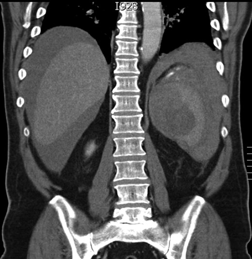 Coronal section of the CT scan showing the abnormal spleen and the haemoperitoneum.