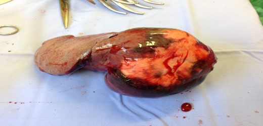 Intraoperative image of the abnormal spleen, showing the area involved in the neoplastic process and the laceration.