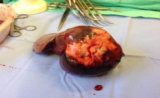 Another intraoperative image of the abnormal spleen and the laceration on its surface.