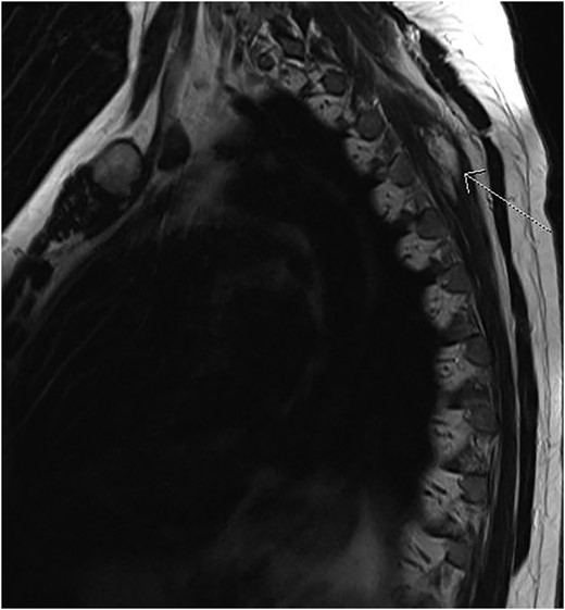 MRI scans shows infiltrating angiolipoma lesion in the left posterior thoracic wall, deeper to trapezius and rhomboid muscles (arrow).