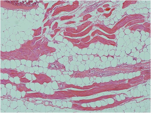 Macroscopic image of fragmented angiolipoma lesion.