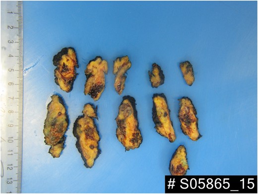 A vascular lesion composed of large thin- and thick-walled blood vessels embedded within adipose tissue. 4Ă— objective under haematoxylin and eosin staining.