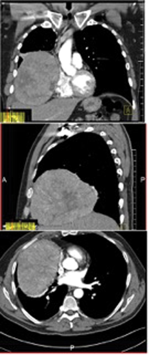 Coronal, sagittal and axial views of the CT scan showing a 15 cm intrapleural mass in the right lower chest cavity.