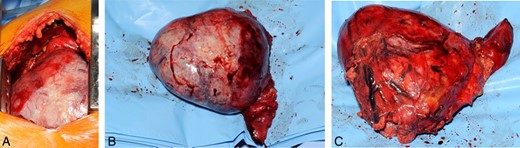 (A) Macroscopic view of the tumour through right anterolateral thoracotomy (surgeon's view from the anterior aspect of the patient); (B) lateral view of the tumour, showing surfaces in contact with chest wall and diaphragm; and (C) medial view of the tumour, notice pedicle clipped.