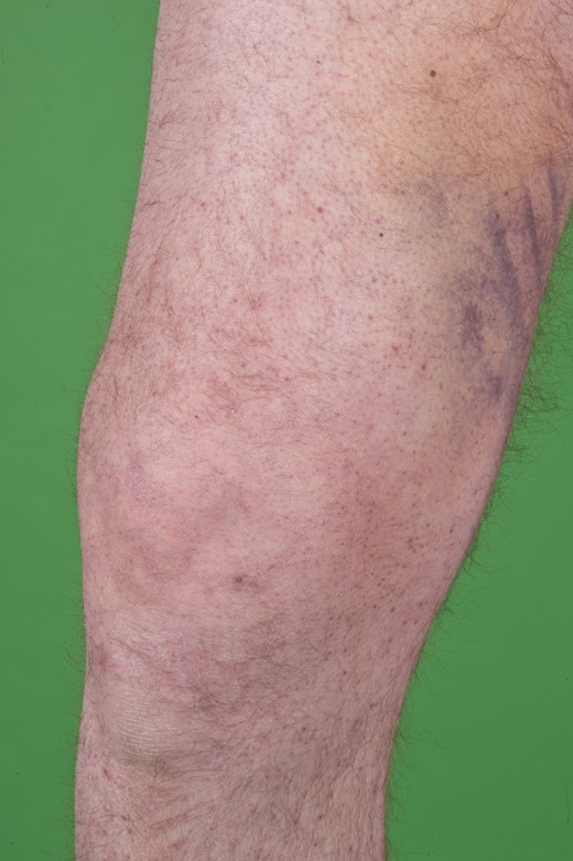 Small bruises on the upper legs.