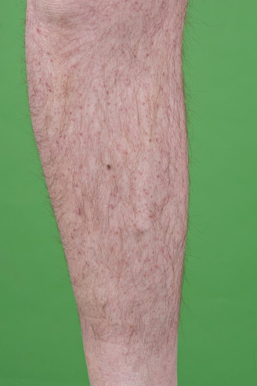 Spots, suspect of petechiae.