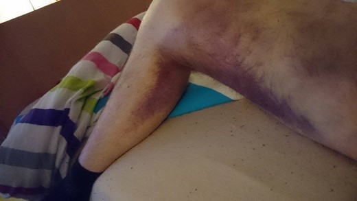 Expansion of bruises after 2 weeks.