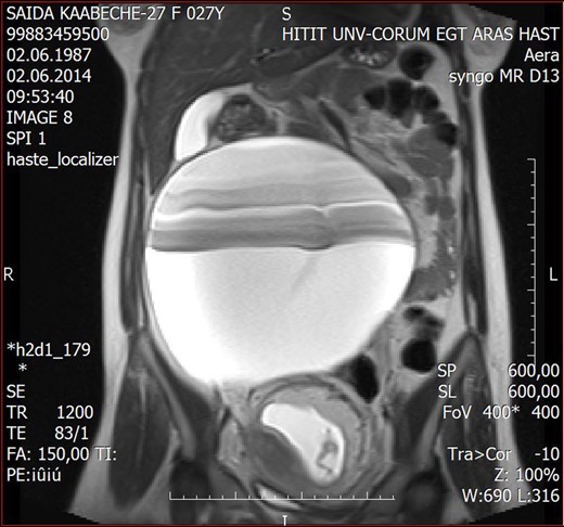 MRI of paratubal cystic mass.