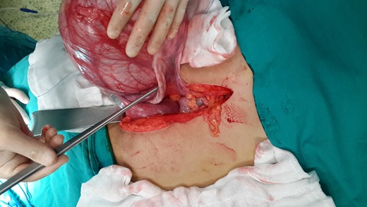 The smooth surfaced cystic mass, originating from the right mesosalpinx.