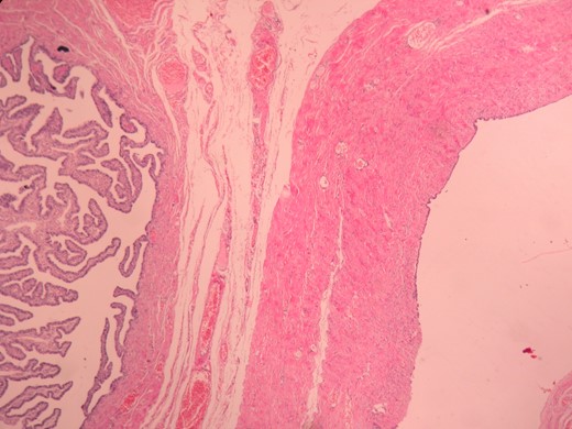 The thick fibrocollagenized wall of the cystic mass, lined with stratified and complex epithelium, H&E, ×200.