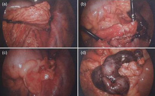 (a) Omentum adherent to sigmoid colon, (b) blunt dissection of inflamed omentum off underlying pathology, (c) sigmoid appendix epiploica appears secondarily inflamed and (d) underlying torted omentum displaying a sharp line of demarcation.