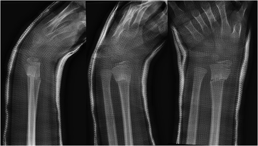 Lateral, oblique and anteroposterior (AP) views of distal radius fracture 2 years prior to presentation of desmoplastic fibroma.