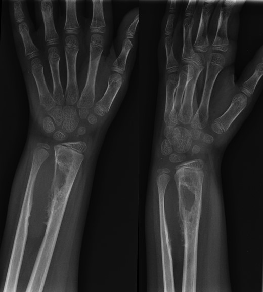 AP and lateral radiographs of the left forearm showing 6.5 cm long lesion in the region of the distal syndesmosis between the radius and ulna.