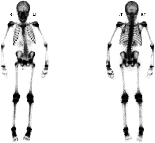 Triple-phase bone scan revealing moderately increased radiotracer uptake in the distal shaft of the left radius and left ulna, as well as in the distal physis of the left radius.