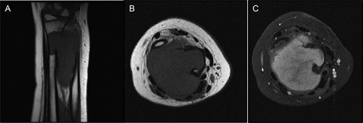 (A and B) T1 MRI showing mass iso-intense to muscle. (C) T2 MRI axial view with overall increased signal intensity, but with a central area of decreased signal.