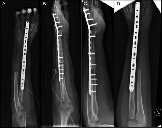 (A and B) Post-operative radiographs of allo-arthrodesis with dorsal plate fixation. (C and D) Follow-up radiographs at 7 months post-op.
