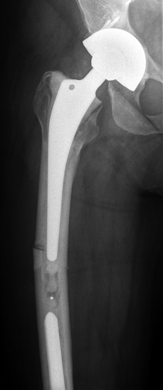 Periprosthetic fracture distal tip of right total hip replacement.