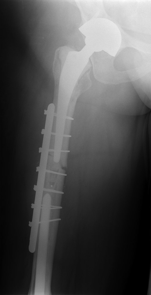 Plate and Dall-Miles cable fixation of periprosthetic fracture.