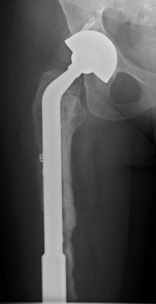 Custom-made cement-linked internal proximal femoral replacement.
