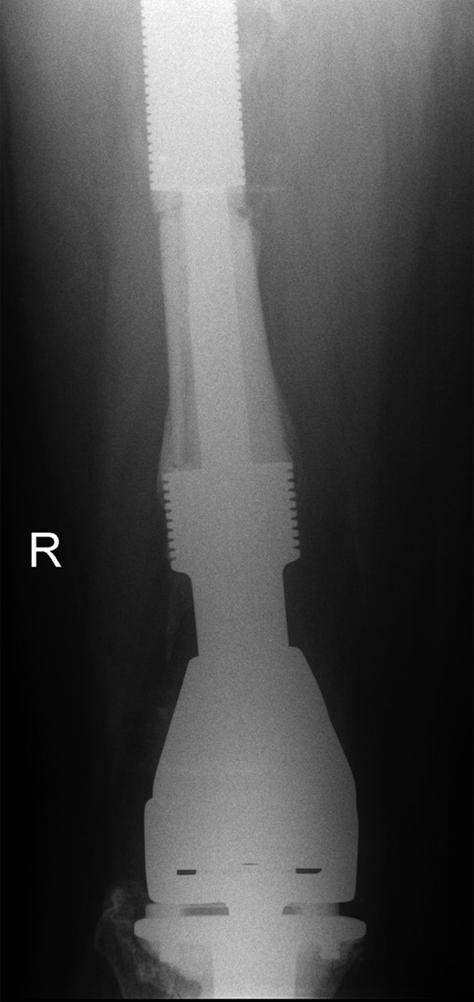 Existing distal femoral replacement with stem linked to custom-made internal proximal femoral component visible in upper half of the image.